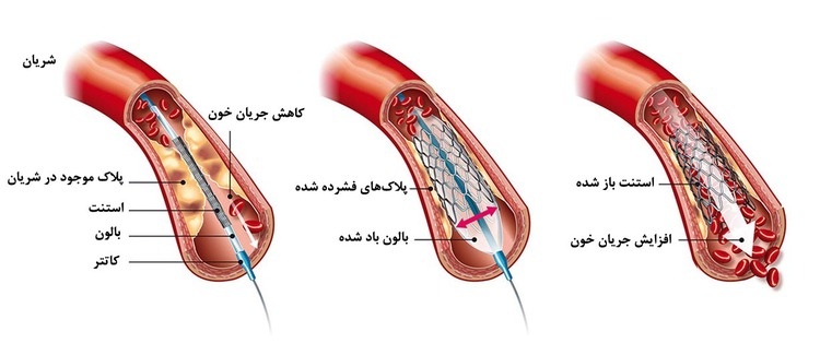 مراحل-آنژیوپلاستی